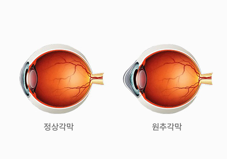 정상각막과 원추각막 비교 그림