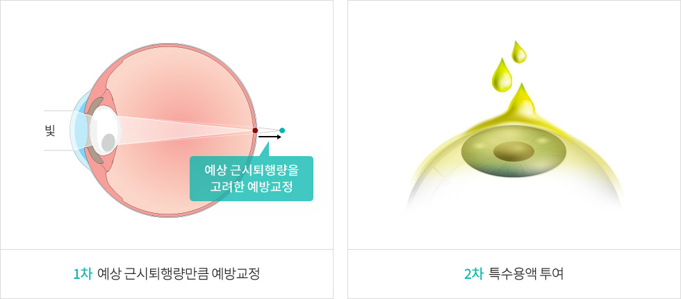 근시퇴행 예방교정·특수물질 투여 과정 그림