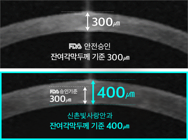 잔여각막두께 기준 비교(미국 FDA 승인기준 300㎛ · 신촌 빛사랑안과 400㎛)