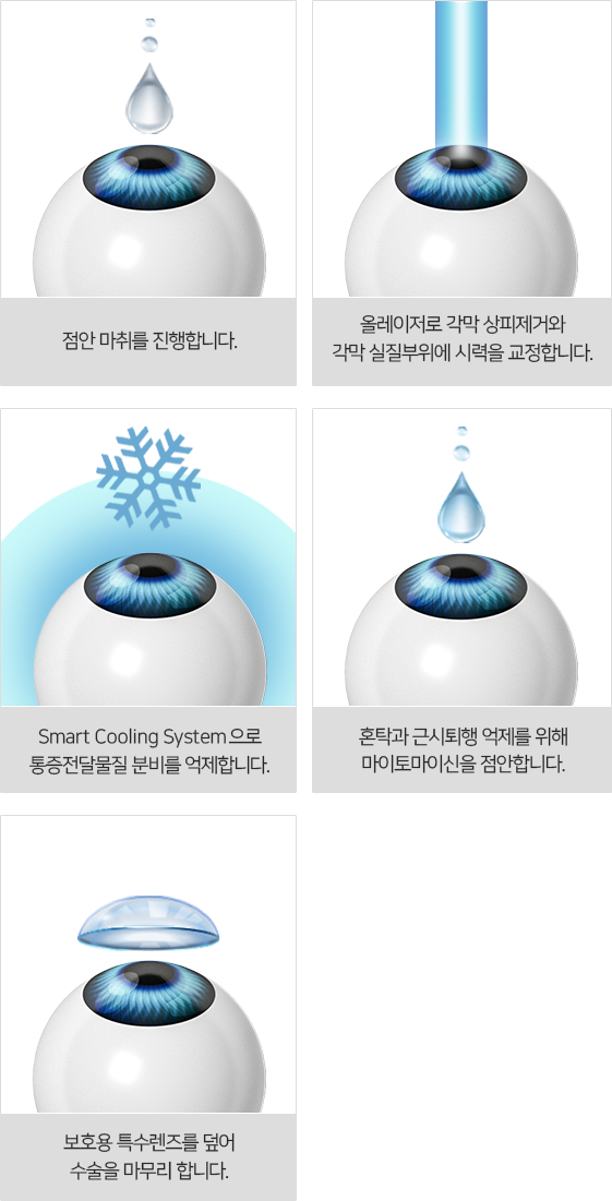 올레이저 무통 M 라섹 수술 과정
