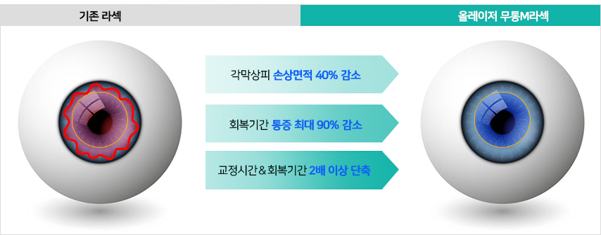 기존 라섹과 올레이저 무통 M 라섹 비교