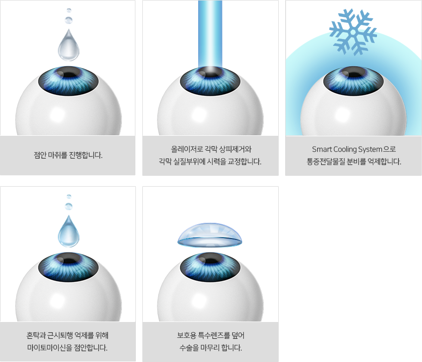 올레이저 무통 M 라섹 수술 과정