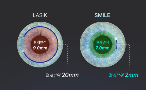 라식과 스마일의 절개 부위 비교