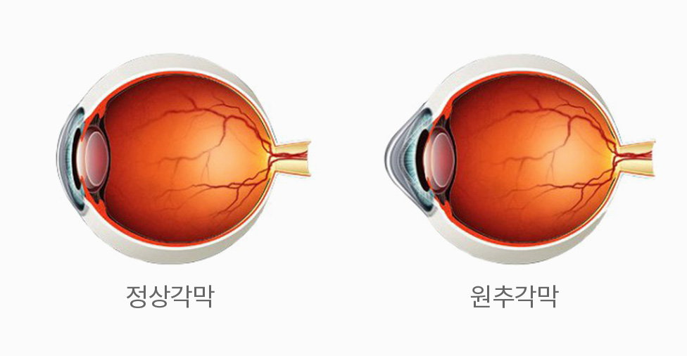 잔여각막두께 기준 비교(미국 FDA 승인기준 300㎛ · 신촌 빛사랑안과 400㎛)
