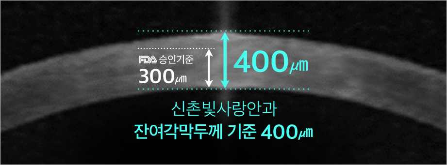 각막 교차결합(CW Cross-linking) 비교 사진