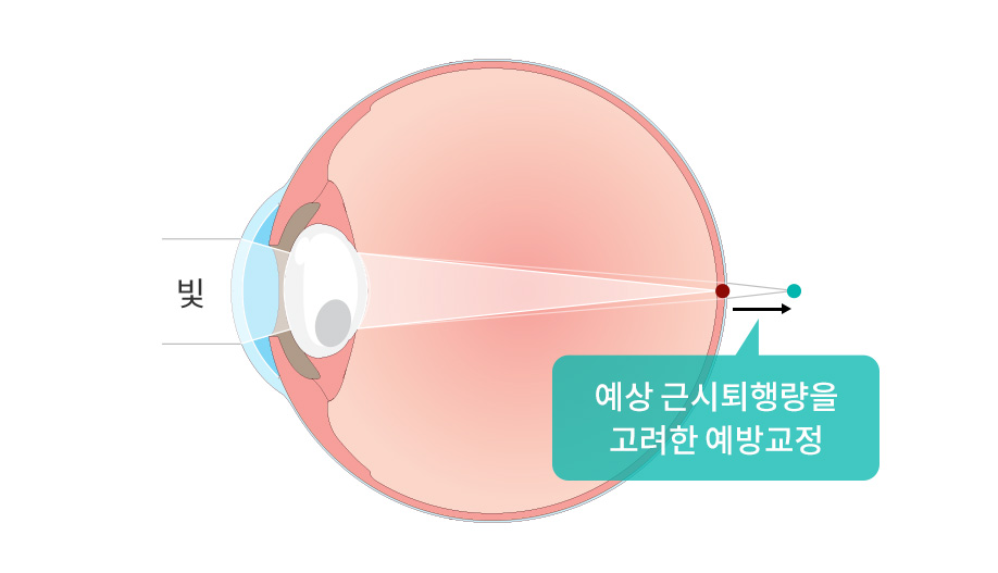 근시퇴행 예방교정·특수물질 투여 과정 그림