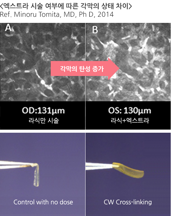 라식·라섹 엑스트라 권장 대상 안내