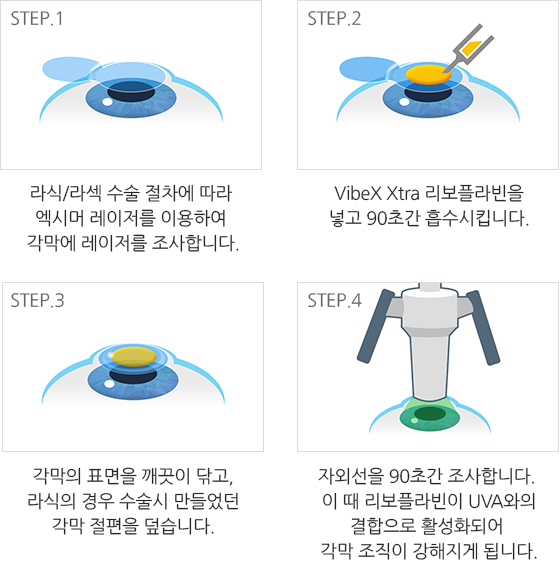라식·라섹 엑스트라의 세 가지 목적(각막 견고·시력 안정·수술 정확)