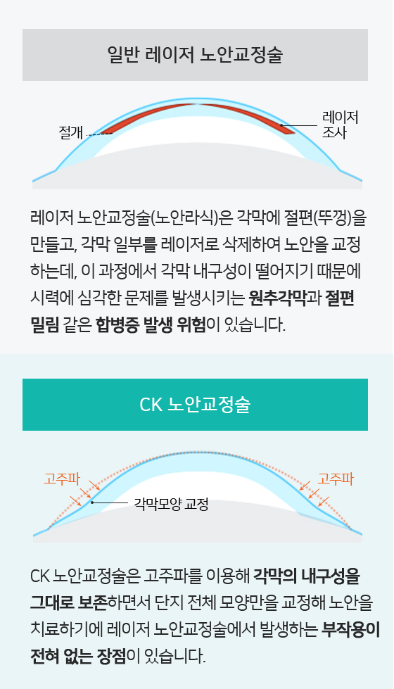 레이저 노안교정술