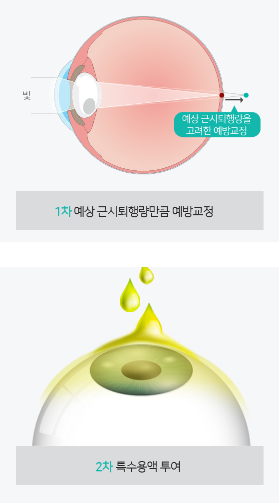 시력저하예방교정