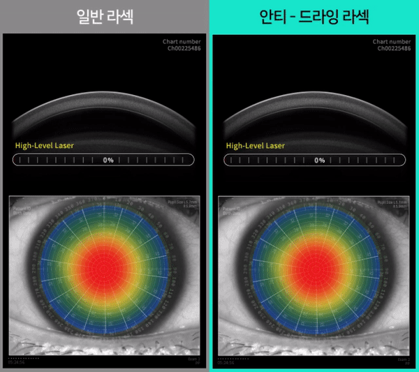 일반 라섹과 안티-드라잉 라섹 비교 영상