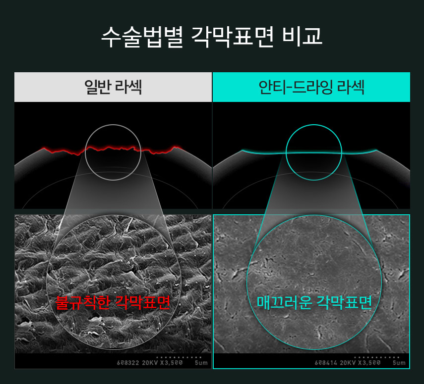 수술법별 각막표면 비교(일반 라섹 · 안티-드라잉 라섹)