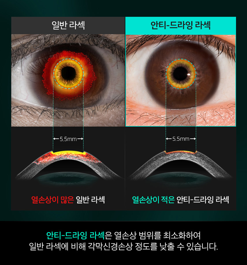 일반 라섹과 안티-드라잉 라섹의 열손상 범위 비교