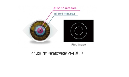 Auto Ref-Keratometer 검사 결과