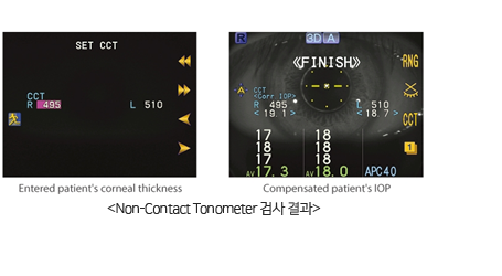 Non-Contact Tonometer 검사 결과