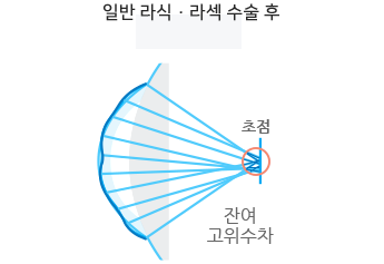 일반 라식·라섹 수술 후 잔여 고위수차