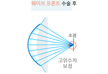 웨이브 프론트 수술 후 고위수차 보정