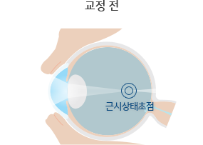 드림렌즈 원리 — 교정 전(근시 초점)