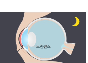 드림렌즈 원리 — 수면 중 렌즈 착용