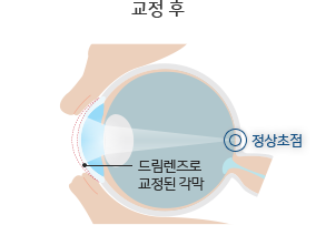 드림렌즈 원리 — 교정 후