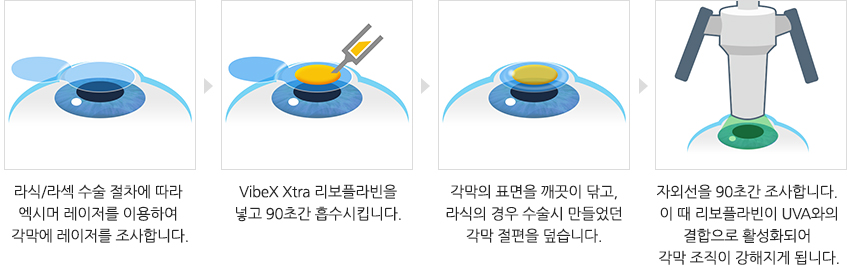 라식·라섹 엑스트라의 세 가지 목적(각막 견고·시력 안정·수술 정확)