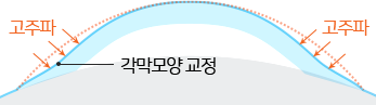 CK 노안교정술