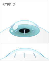 CK 노안교정술