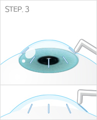 CK 노안교정술