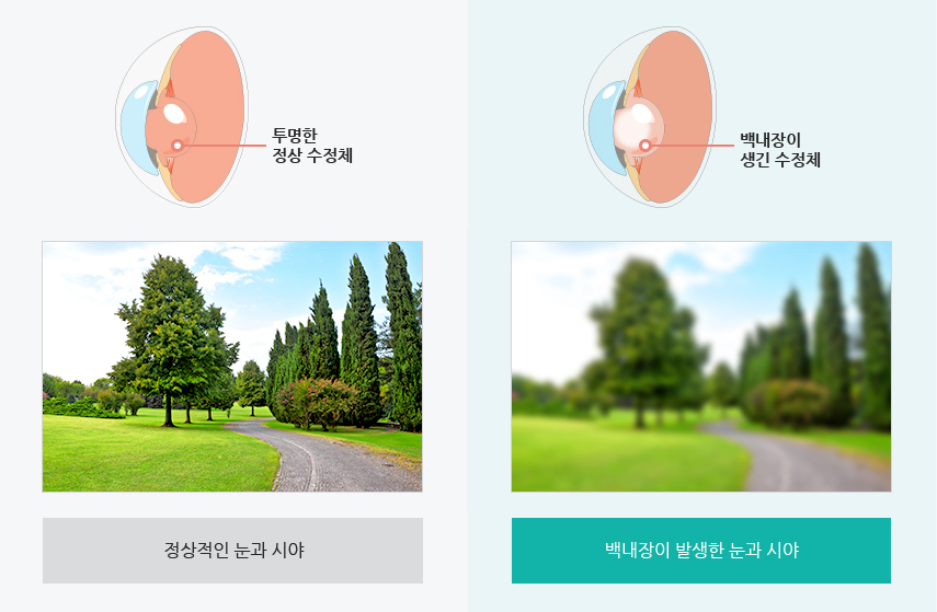 눈의 단면