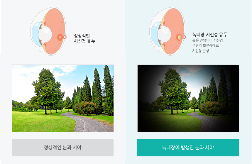 눈의 단면