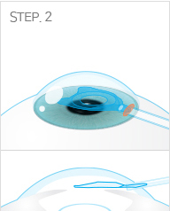 ICL 렌즈삽입술 과정 STEP 2