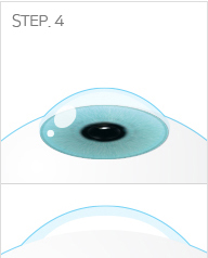 ICL 렌즈삽입술 과정 STEP 4